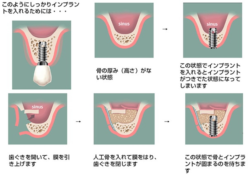 サイナスリフトの手順図解。骨の厚みが不足している上顎にインプラントを埋入すると突き出てしまうため、歯ぐきを切開して上顎洞の膜を引き上げ、人工骨を填入した後に骨とインプラントが固まるのを待つ流れを6段階で示しています。