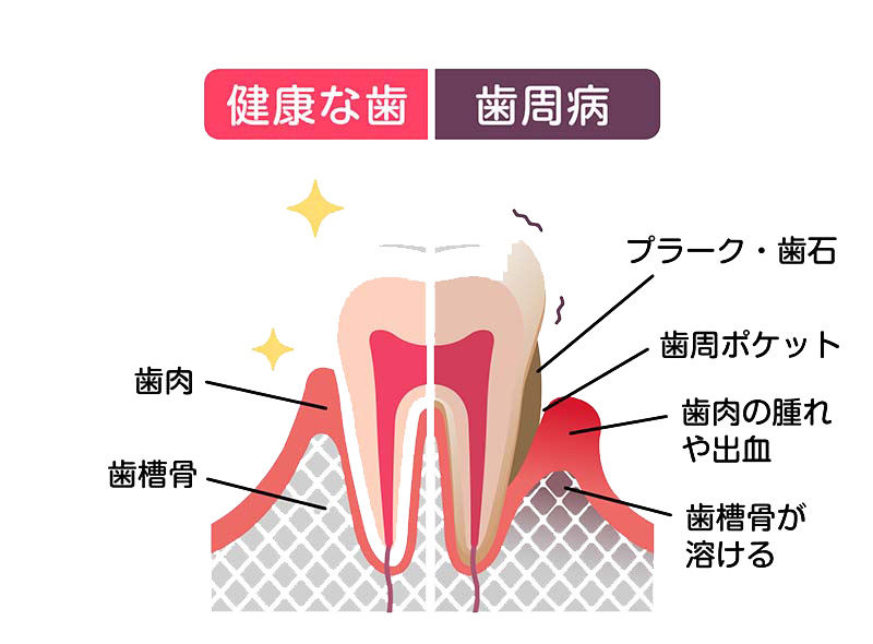 健康な歯と歯周病の歯の断面比較図。歯周病側にはプラーク・歯石の付着、歯周ポケットの形成、歯肉の腫れや出血、歯槽骨が溶ける状態が示されており、健康な歯との違いを視覚的に説明しています。