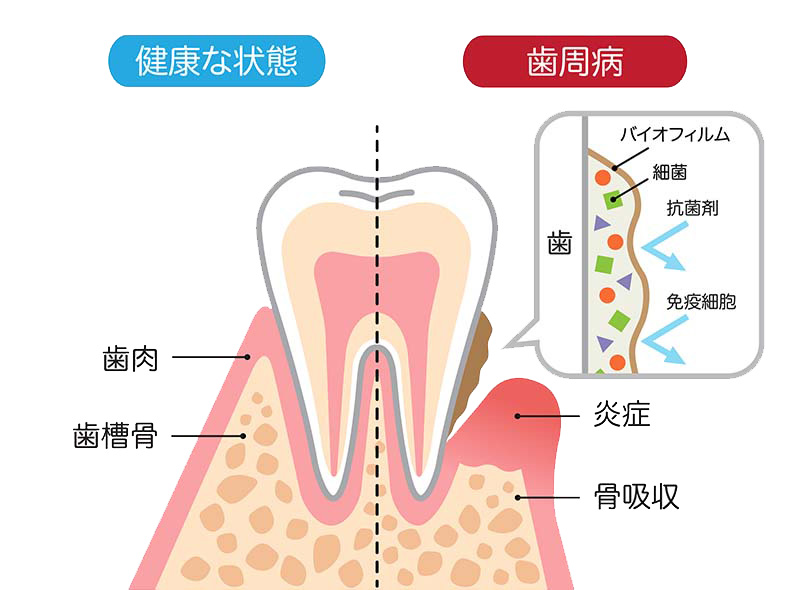 健康な状態と歯周病の歯の断面比較図。健康な状態では歯肉と歯槽骨が正常に保たれているのに対し、歯周病では炎症と骨吸収が起きている状態を示す。拡大図にはバイオフィルム・細菌・抗菌剤・免疫細胞が描かれ、細菌が歯に付着するメカニズムを説明しています。
