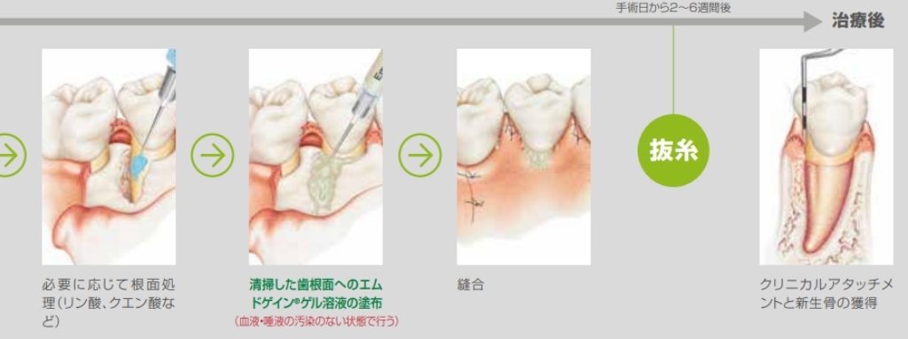 エムドゲイン療法の流れ（根面処理〜治療後）：エムドゲインゲルの塗布・縫合・抜糸・クリニカルアタッチメントと新生骨の獲得の手順イラスト