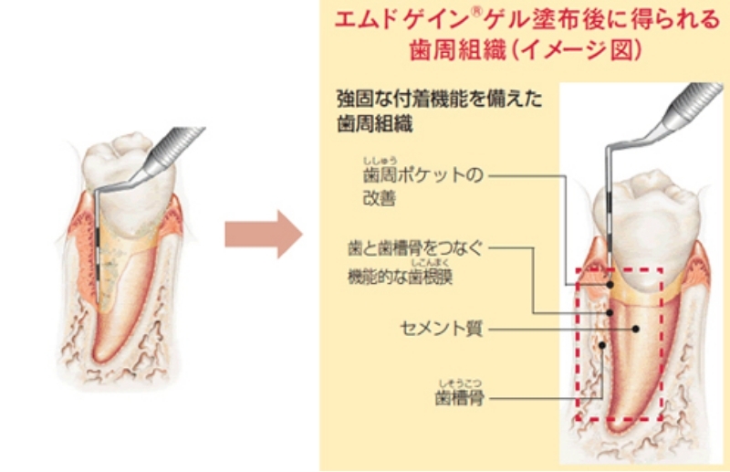 エムドゲインゲル塗布後に得られる歯周組織のイメージ図：歯周ポケットの改善、機能的な歯根膜、セメント質、歯槽骨の再生を示す図解