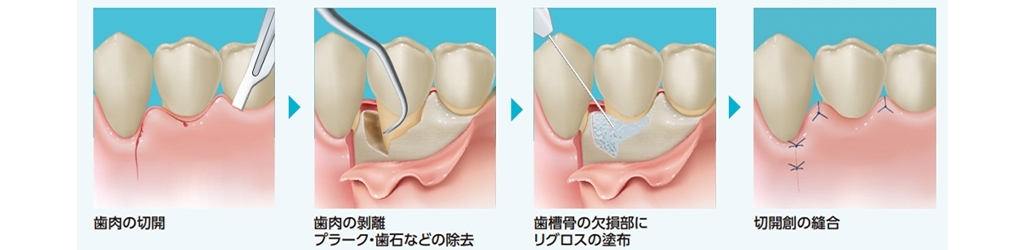 リグロス療法の手順イラスト：歯肉の切開・歯肉の剥離とプラーク歯石の除去・歯槽骨欠損部へのリグロス塗布・切開創の縫合
