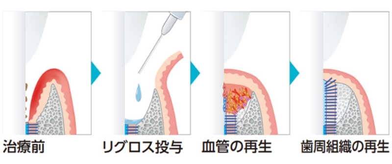 リグロスの効果メカニズムイラスト：治療前・リグロス投与・血管の再生・歯周組織の再生の4段階を示す図解